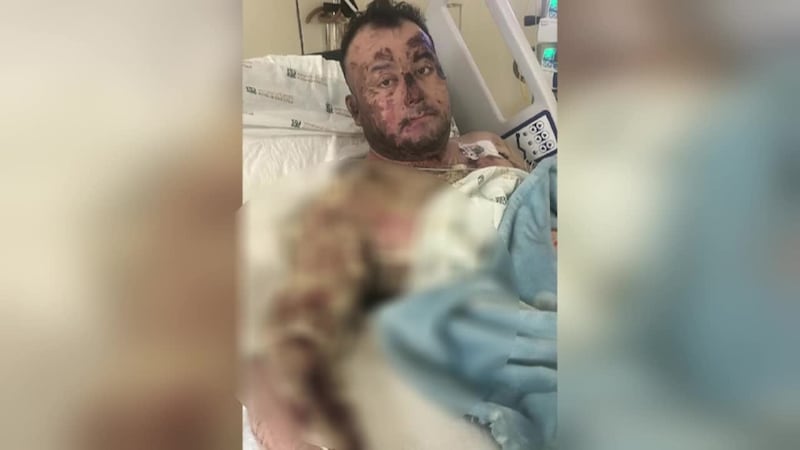 Padre de familia quedó electrocutado y con quemaduras de tercer grado al tocar cableado...